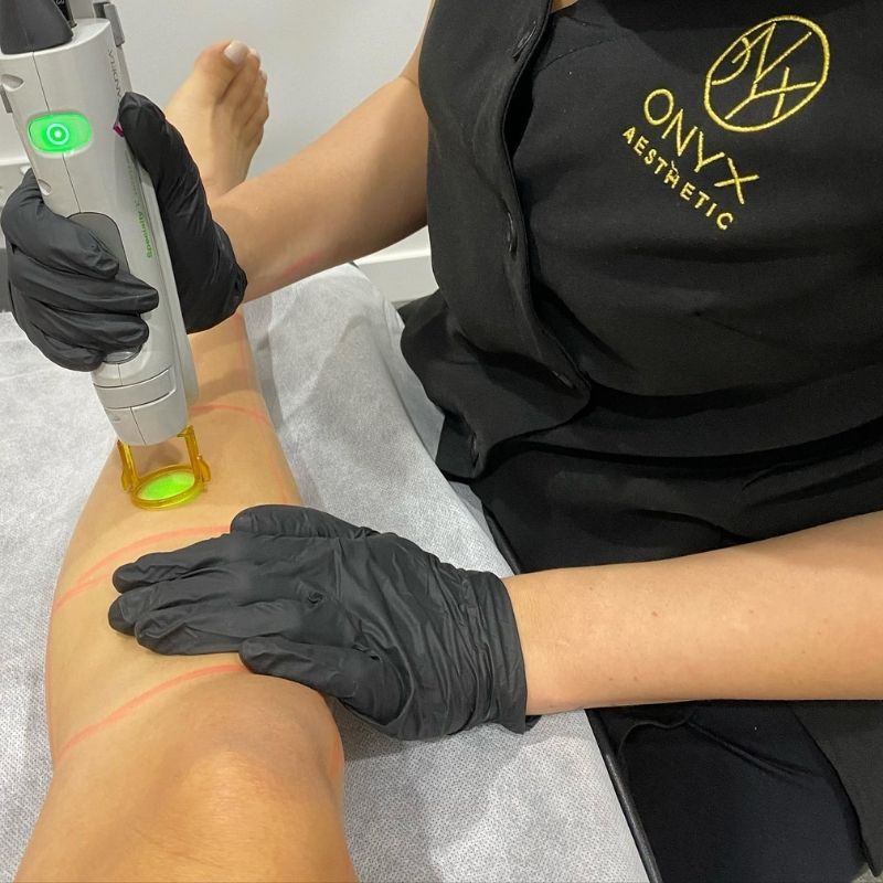 Onyx Aesthetic Laser Hair Removal
